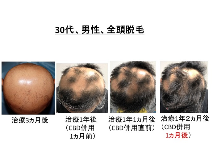 円形脱毛症　病院